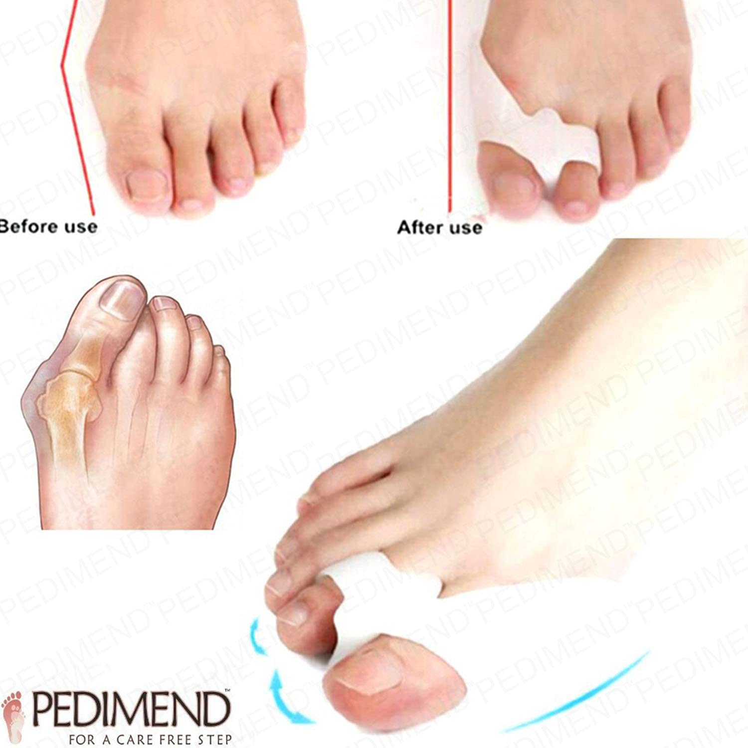 Pedimend Silicone Gel Toe Separator (8 PCs) to Align Toes - Bunion Toe Treatment, Big Toe Straightener, Toe Cushion, Avoid Friction Shoes - Toe Alignment Support – UNISEX - Foot Care