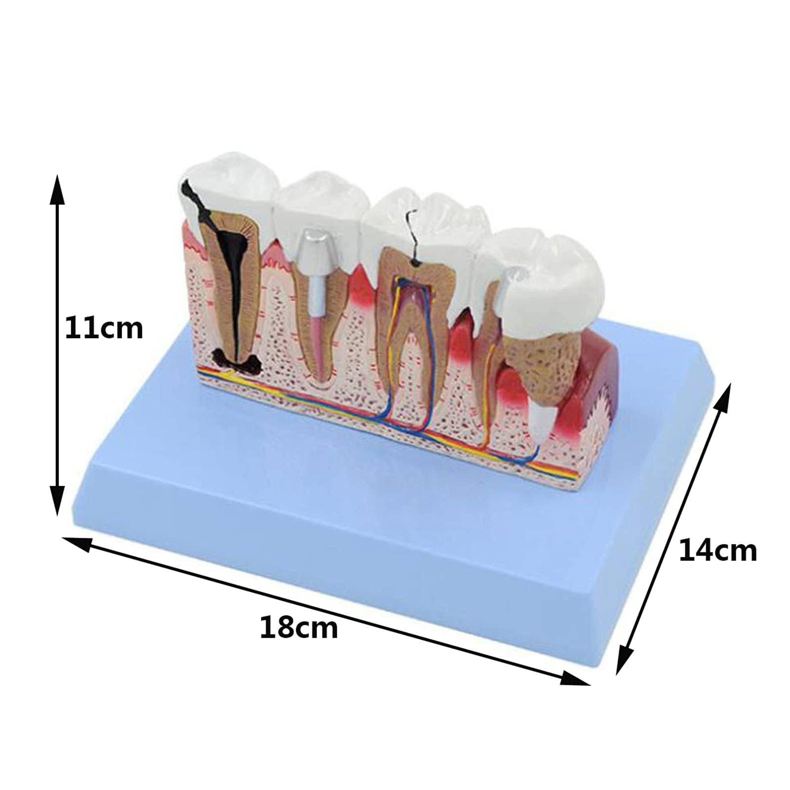 Model zębów dentystycznych, model anatomii zębów ludzkich, z instrukcjami, demonstracja patologii, model dentystyczny, do gabinetu dentystycznego, narzędzie edukacyjne