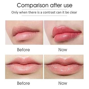 Amazon.co.jp: 20個ヒアルロン酸注射アンプルヘッドしわ除去高圧