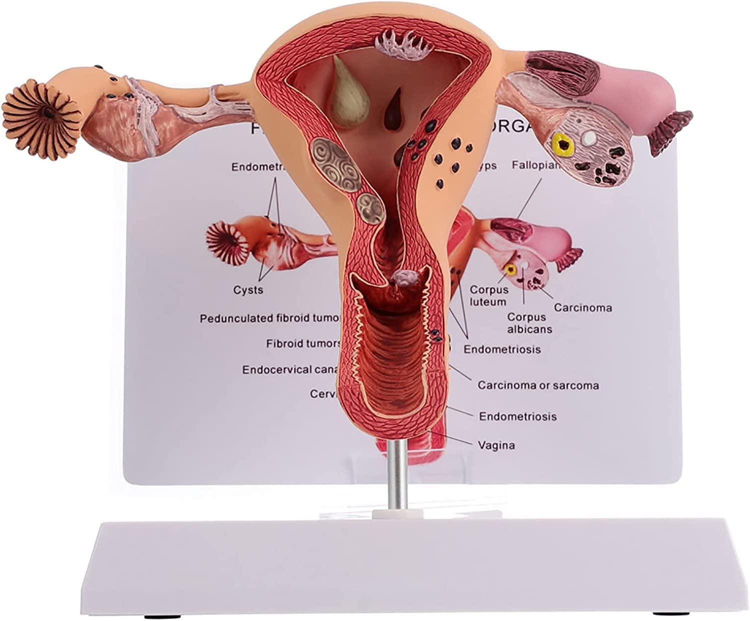 BITWIT Female Reproductive Organs Uterus Model Anatomy Model,1Pcs Pathological Uterus and Ovary Anatomical Model, for School Hospitals Teaching Human Female Medical Anatomy