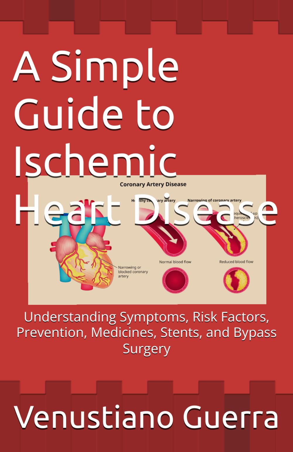 A Simple Guide to Ischemic Heart Disease: Understanding Symptoms, Risk Factors, Prevention, Medicines, Stents, and Bypass Surgery (Medical Publications for lay people)