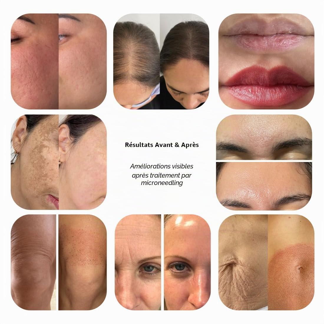 Dr.pen Ultima M8S Microneedling Pen, Stylo Derma Sans Fil avec 20 Cartouches de Rechange