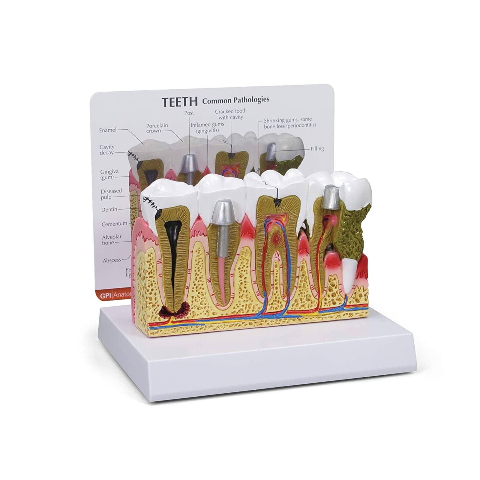 Dentalmodell, Anatomie des menschlichen Körpers, Nachbildung von Zähnen mit/häufigen Pathologien, für die Zahnarztpraxis, Lehrmittel, Anatomicals