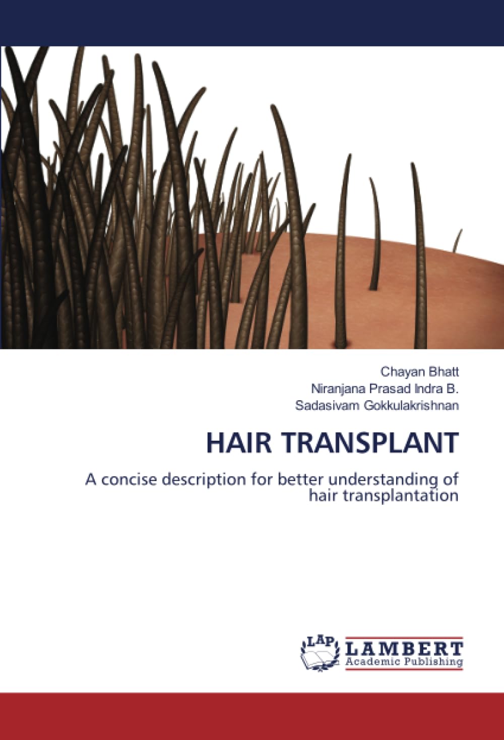 HAIR TRANSPLANT: A concise description for better understanding of hair transplantation