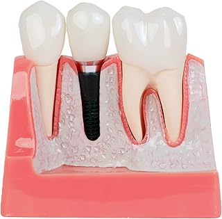 Axis Scientific Enlarged Dental Implant Anatomy Model
