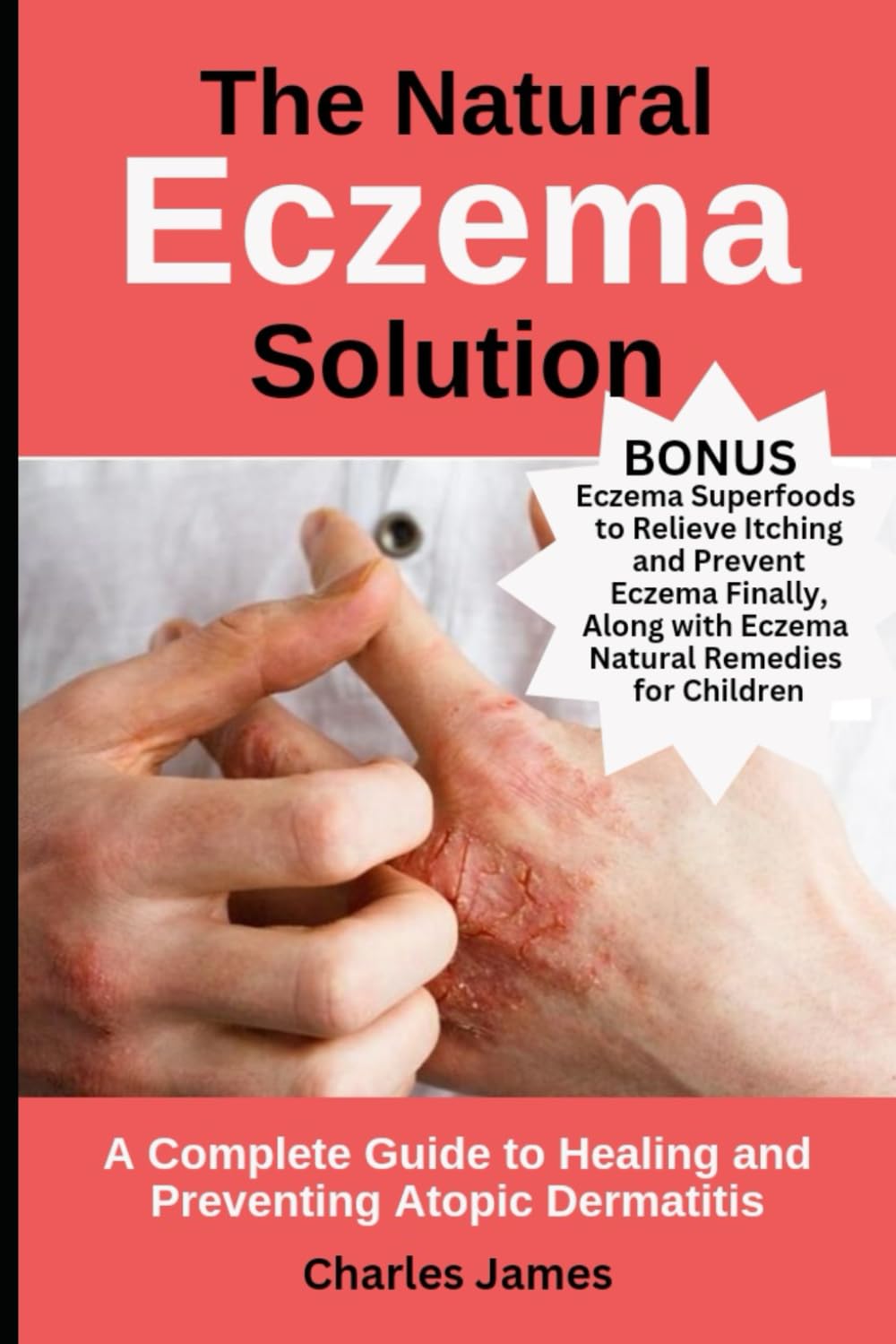 The Natural Eczema Solution: A Complete Guide to Healing and Preventing Atopic Dermatitis