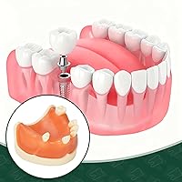 Vista 5 de Ultrassist Modelo de implante dental maxilar, modelo básico de entrenamiento de implantes con práctica de encías blandas, gran diente