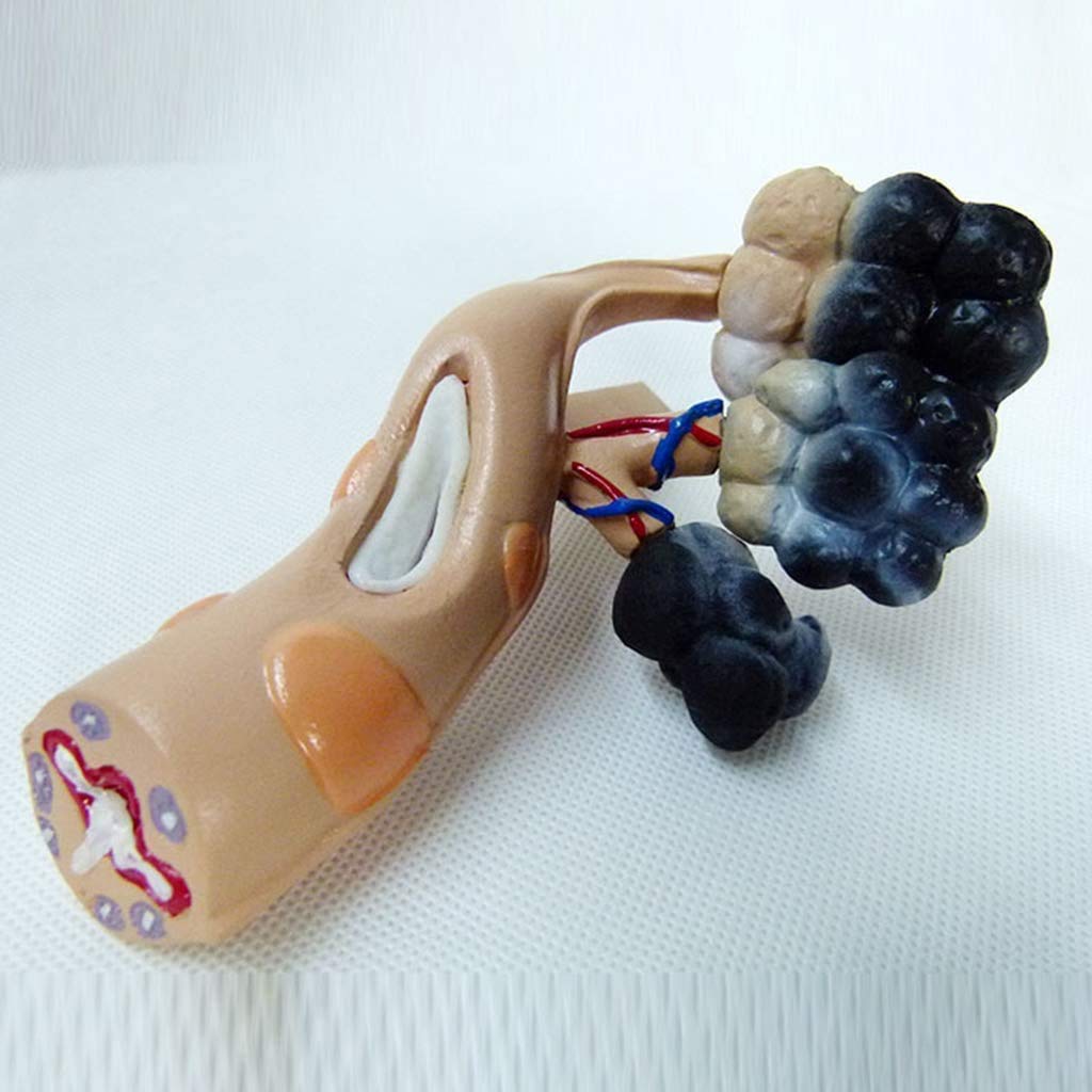 Educational Modell alveolar Modell - Vergleichende Anatomie Alveolen Rauchen und gesundes Zellmodell der medizinischen Studie - Anatomisches Modell