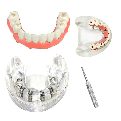 Modelo inferior de sobredentadura dental, modelo de demostración extraíble de 6 uñas modelo de demostración para investigar dentista médico, enseñar
