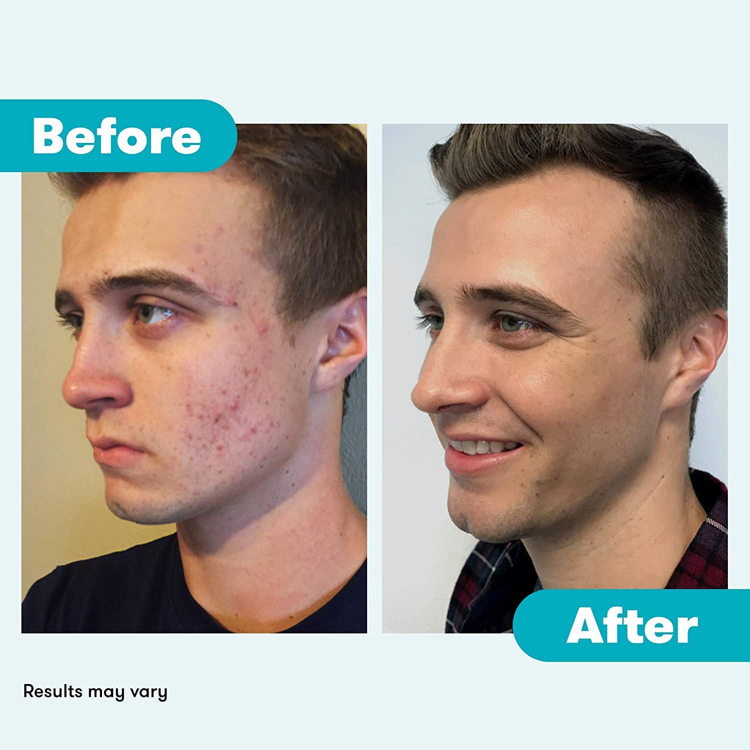 Proactiv Acne Cleanser - Benzoyl Peroxide Face Wash and Acne Treatment - Daily Facial Cleanser and Hyularonic Acid Moisturizer with Exfoliating Beads - 90 Day Supply, 6 Fl Oz - Image 6