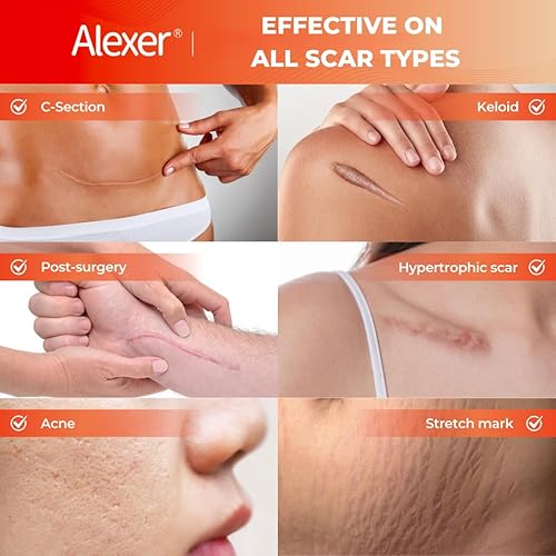 Miniatura 2 de Hojas de silicona para cicatrices, cinta de silicona para cicatrices, (rollo de 1.6 x 60 pulgadas - 4.9 ft), cinta de cicatriz para cicatrices