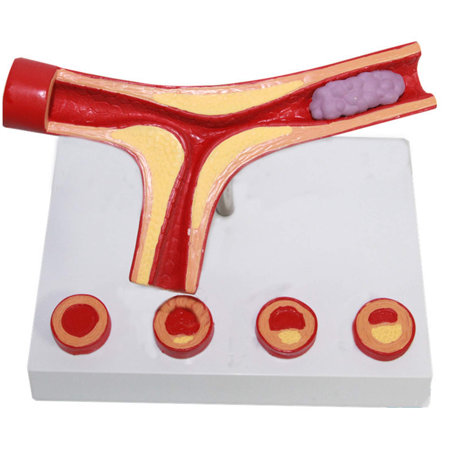 Model układu sercowo-naczyniowego ludzkiej miażdżycy, model anatomiczny naczyń krwionośnych, model skrzepliny do medycznych materiałów dydaktycznych
