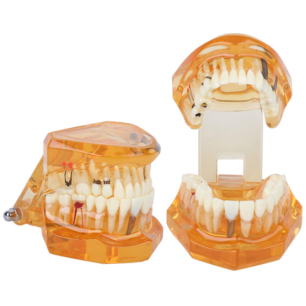 Modelo de Dientes para Demostración de Enfermedades Dentales Extraíble, Educativo Anatómico Profesional para Enseñanza Dental