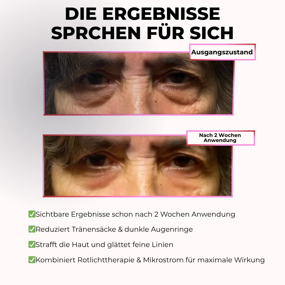 GlowEyes Pro - 2-in-1 Rotlichttherapie + EMS zur Beseitigung von Augenringen Augenmassagegerät mit Rotlichttherapie Reduziert Schwellungen und Falten um die Augen