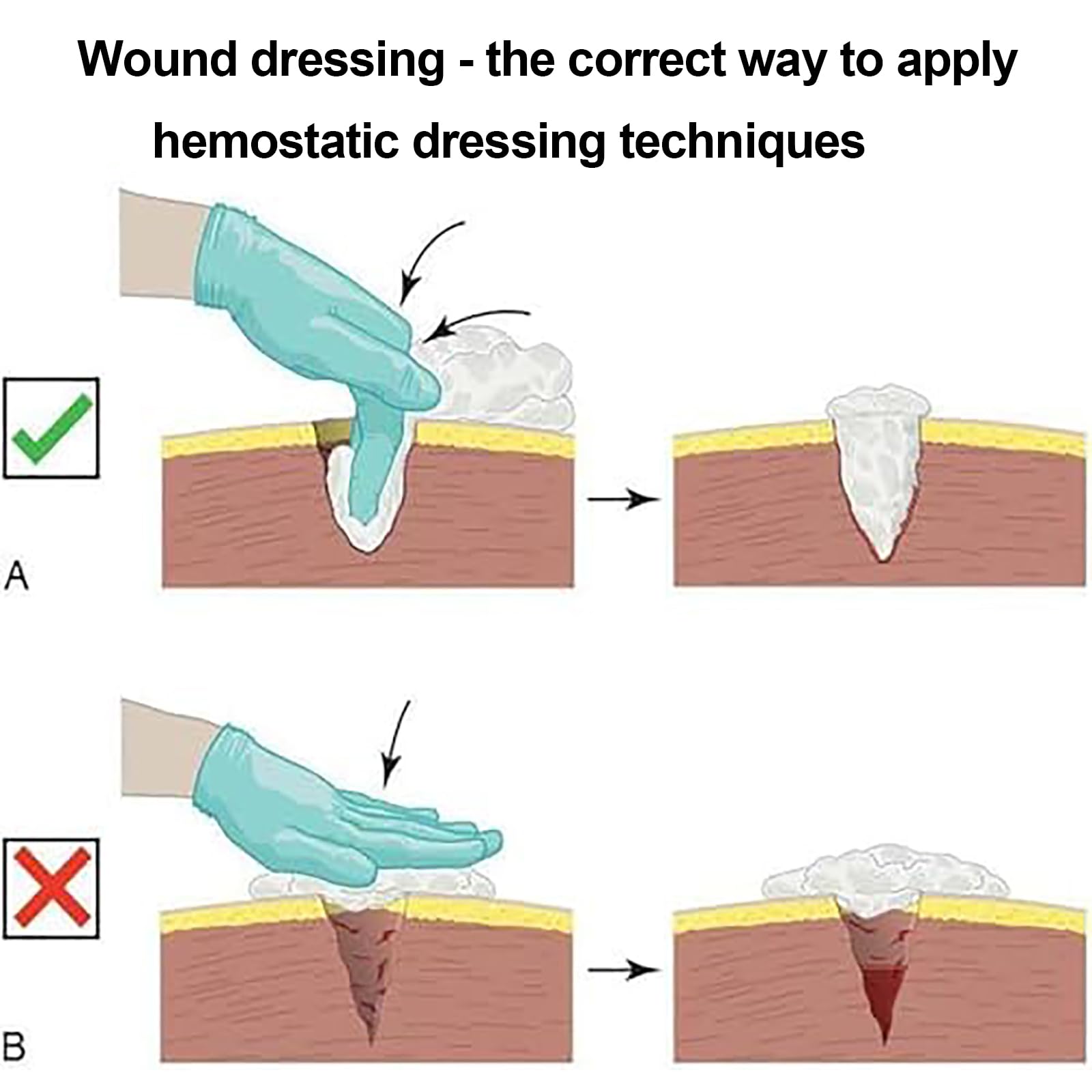 Modelo De Entrenamiento para El Control De Hemorragias, Simula El Empaquetamiento De Heridas Y El Uso De Torniquetes, Lavable Y Reutilizable, para Practicar Técnicas De Apósitos Hemostáticos.