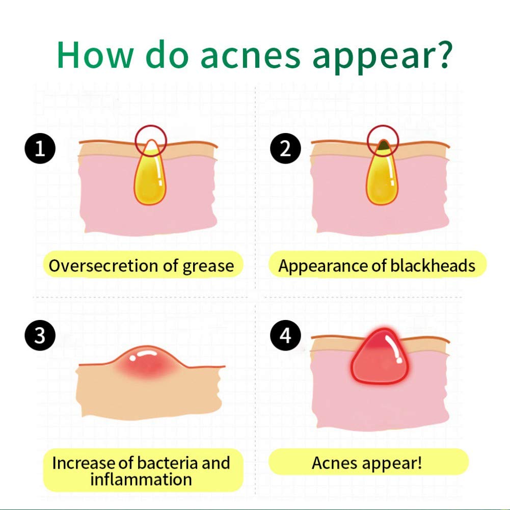 Reparación del acné cicatrices Crema antiacné facial Crema antiacné Crema antiacné Pimple Oil Control Reencoger los poros Sérum Hidratante para la cara