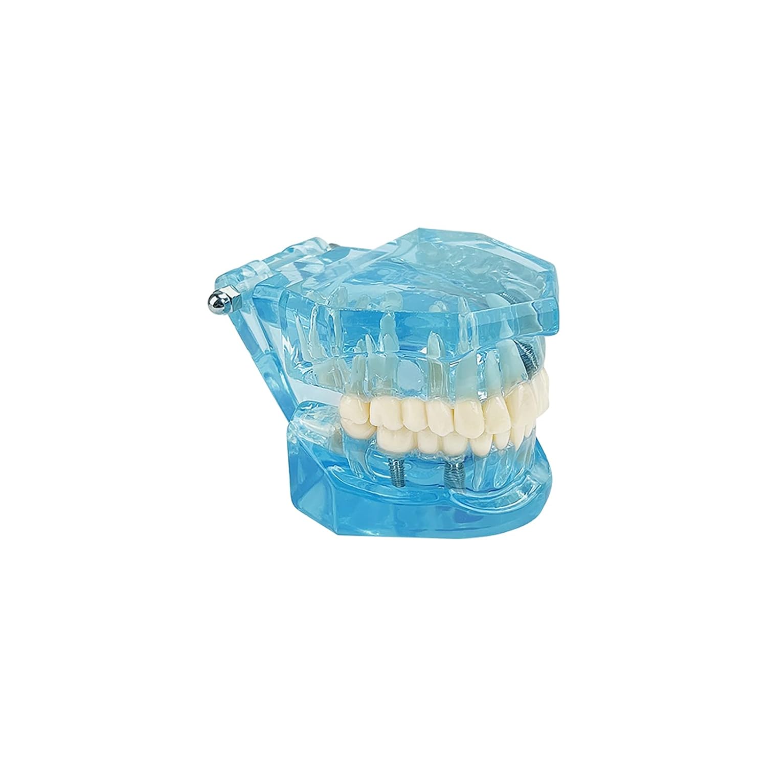 Transparent Disease Teeth Model, YOUYA DENTAL Transparent Dental Implant Teeth Model Dentist Standard Disease Removable Tooth Pathological Teaching Model(Blue)