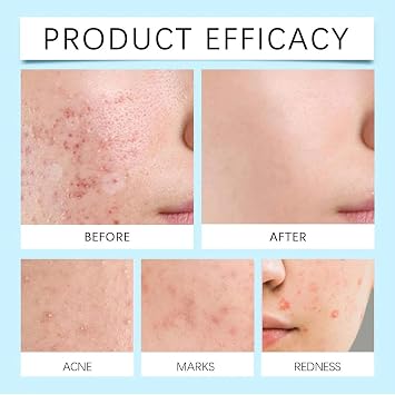 Retinol Gel for Acne Improvement, 20g Face Moisturizer with Skin Soothing Formula, Reduces Blemishes, Suitable for Combination and Oily Skin