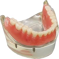 Vista 2 de Demostración de implantes inferiores de 4 implantes para enseñar y estudiar