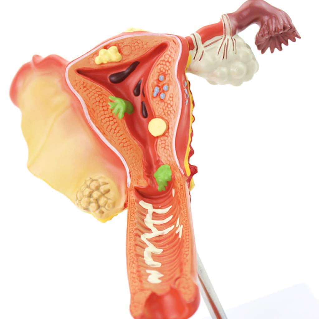 PVC Anatomical Human Pathological Breast Model, Medical Disease and Cancer Anatomy for Patient Education