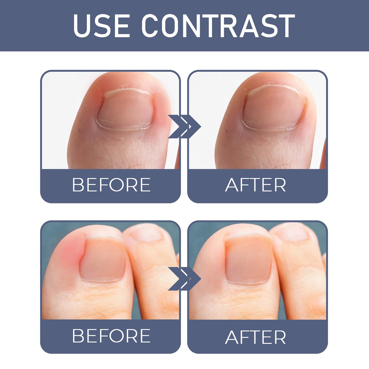 Ingrown Toenail Treatment Extra Strength, Toe Nail Softener, Ingrown Nail Treatment Oil, Supports Nail Growth - Image 4