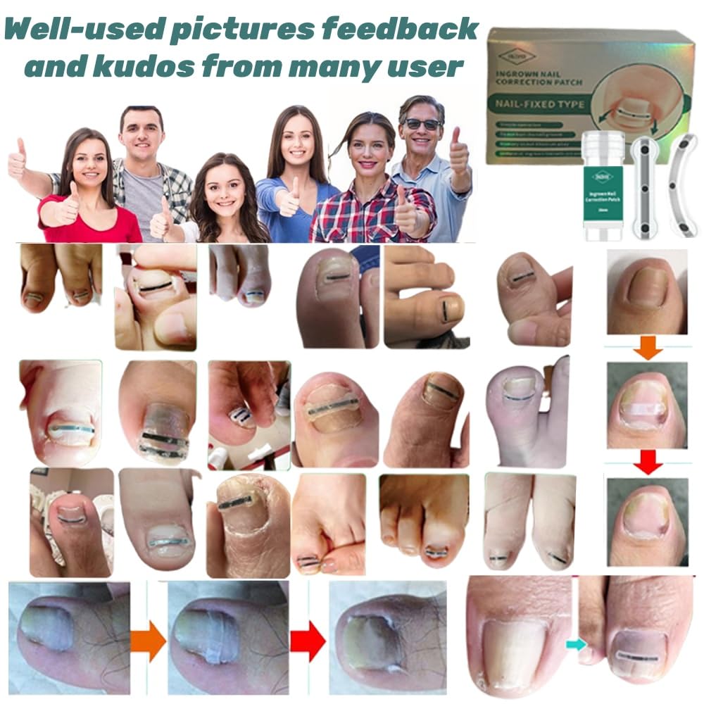 Ingrown Toenail Corrector & Removal Kit - at Home Treatment for Ingrown Toenails, Titanium Alloy Ingrown Toenail Treatment Tools Designed for Curved Nail Repair Suitable for Men Woman (0.59/0.67in)