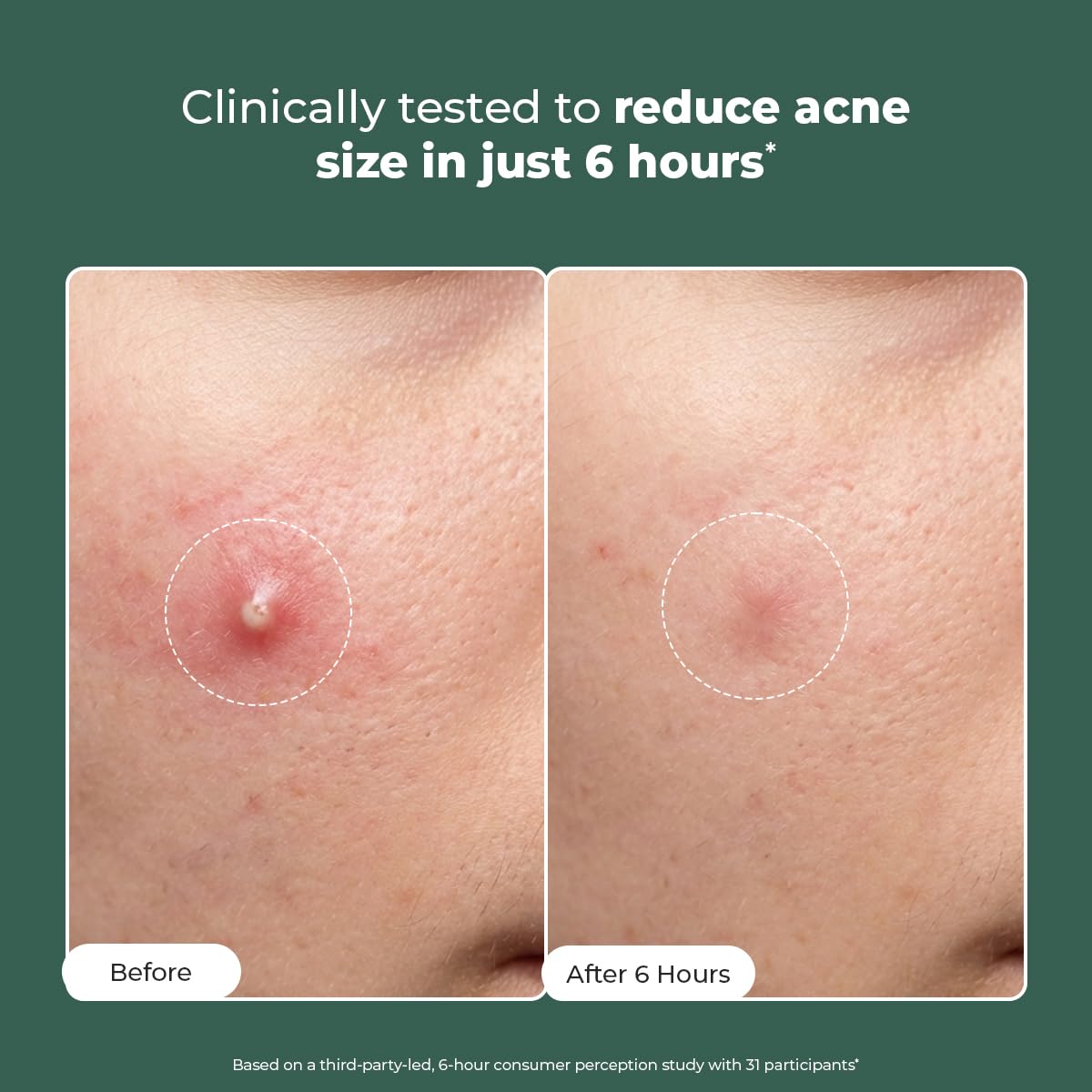 Conscious Chemist® Rapid Relief Acne Spot Corrector Gel 15g | 2% Salicylic Acid & Azelaic Acid Acne Spot Treatment | Pimple Removal Gel for Active Acne, Redness & Dark Spots | Fast-Acting Spot Corrector for Men & Women