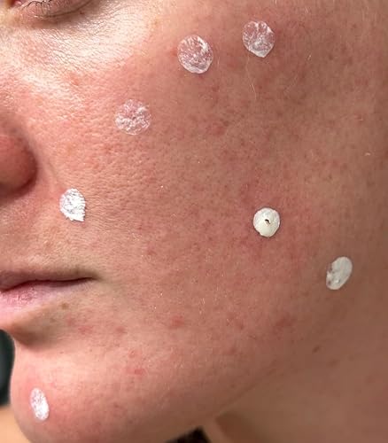 Miniatura 2 de LANBENA Precision Suero para Puntos de Acné, Loción Secante para Acné, Tratamiento Nocturno contra el Acné para el Rostro, Seca Espinillas