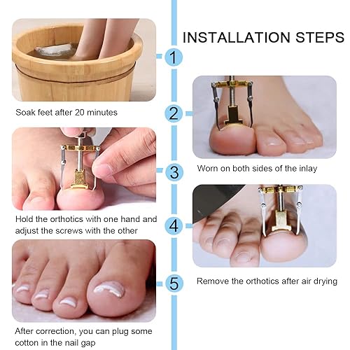 Miniatura 2 de Ingrown Toenail Corrector Professional Ingrown Toenail Lifter Practical Toe Clamp for Ingrown Toenail Treatment