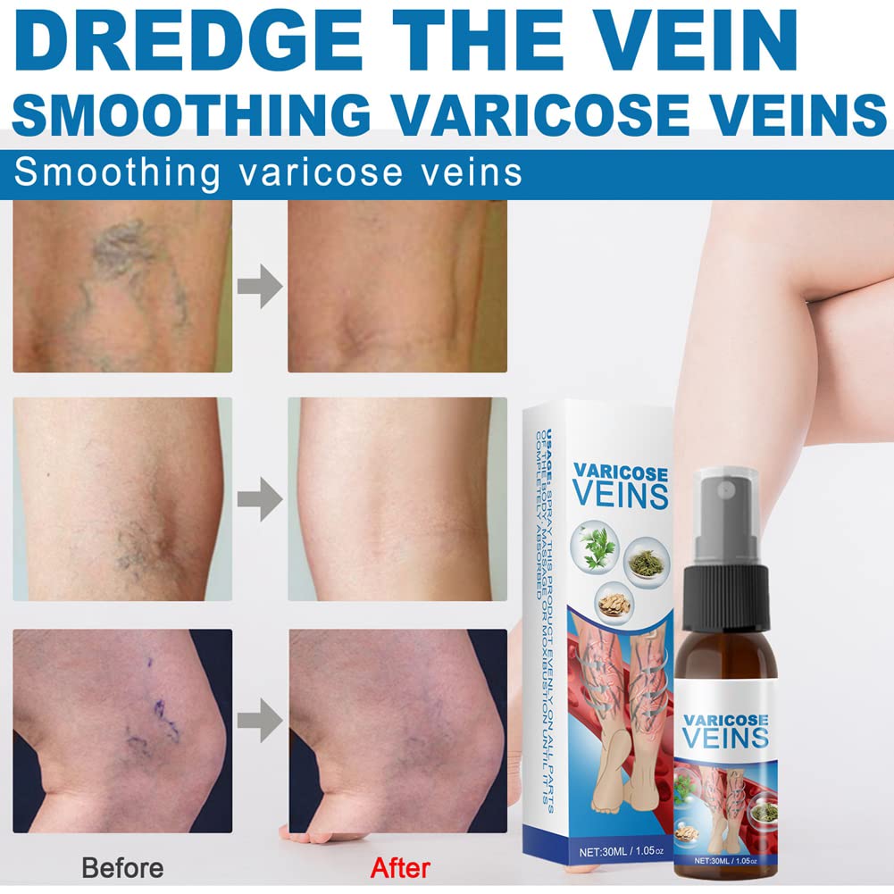 Spray Calmante para Venas Varicosas, Varices Venas Milagrosa Spray, Spray para Tratamiento de Venas Varicosas, Pierna de Alivio Dolor, Mejora La Circulación Sanguínea