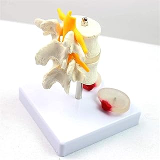 Study Model Educational Model Anatomical Skeletal Model of Diseased Intervertebral Disc Model - Human Lumbar Spine Model - Medical Anatomical Human Spine Model - for Medical Educational Training