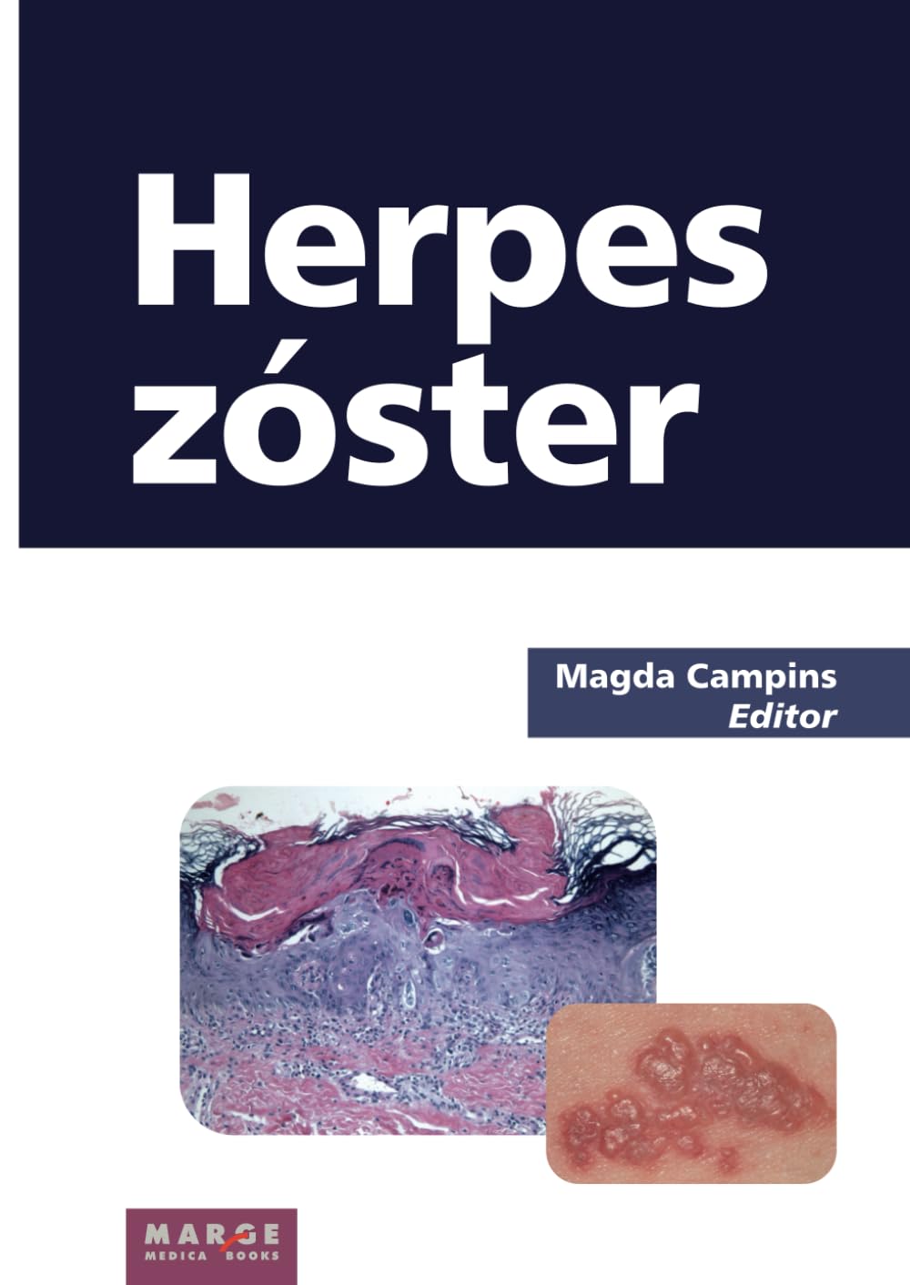 Herpes zóster (Medicina y Ciencias de la Salud)