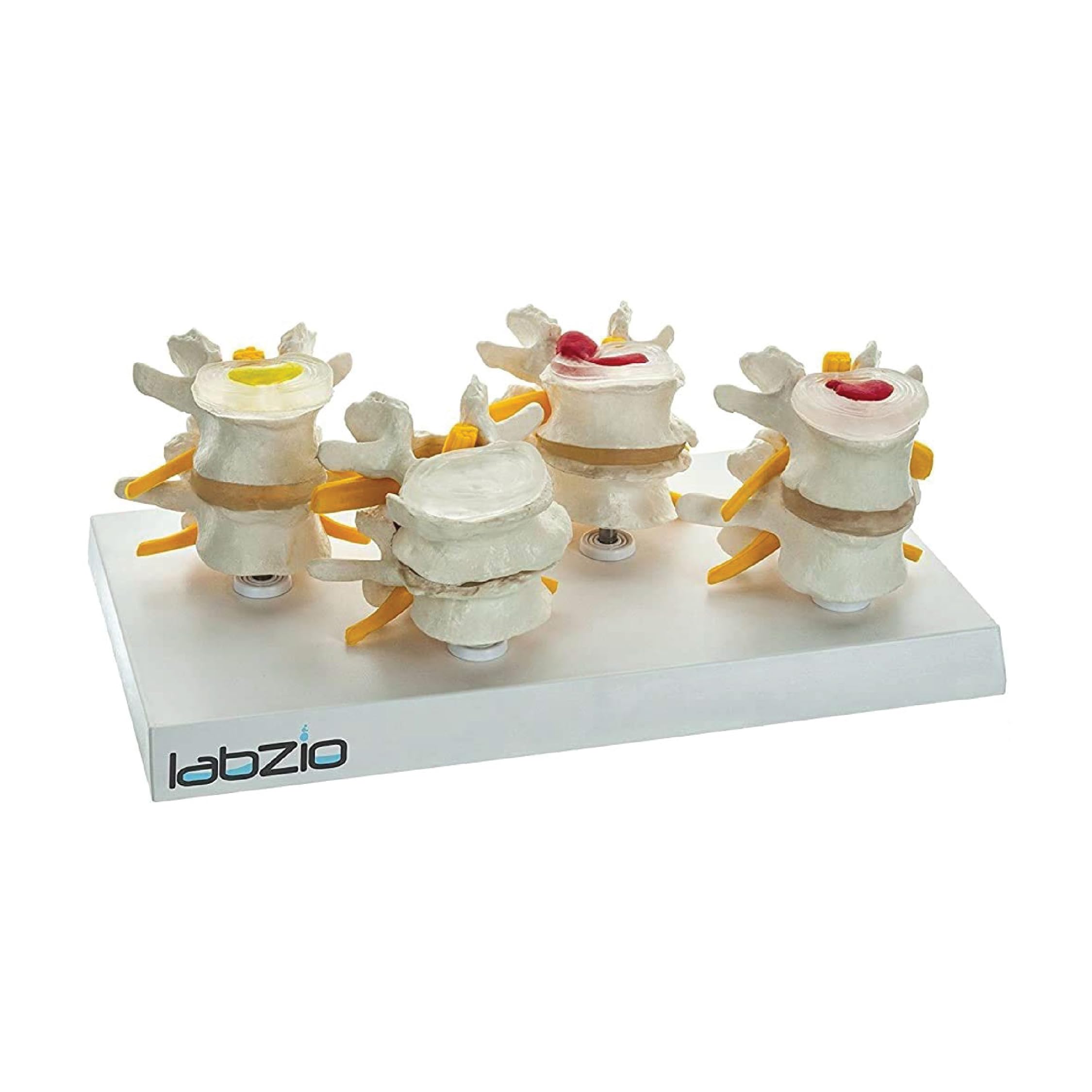 4 Stage Vertebrae Diseases Model, 4 Parts, Removable, Premium Anatomical Model, Model On Base With Detailed Study Guide, White