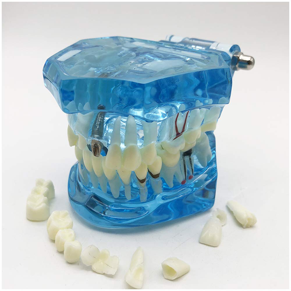 Modello di Denti da 2 Pezzi, Modello di Analisi di Studio di Impianti Dentali per Riparazione di Carie Dentale, Modello Dimostrativo per L'Insegnamento Medico, Forniture di Laboratorio