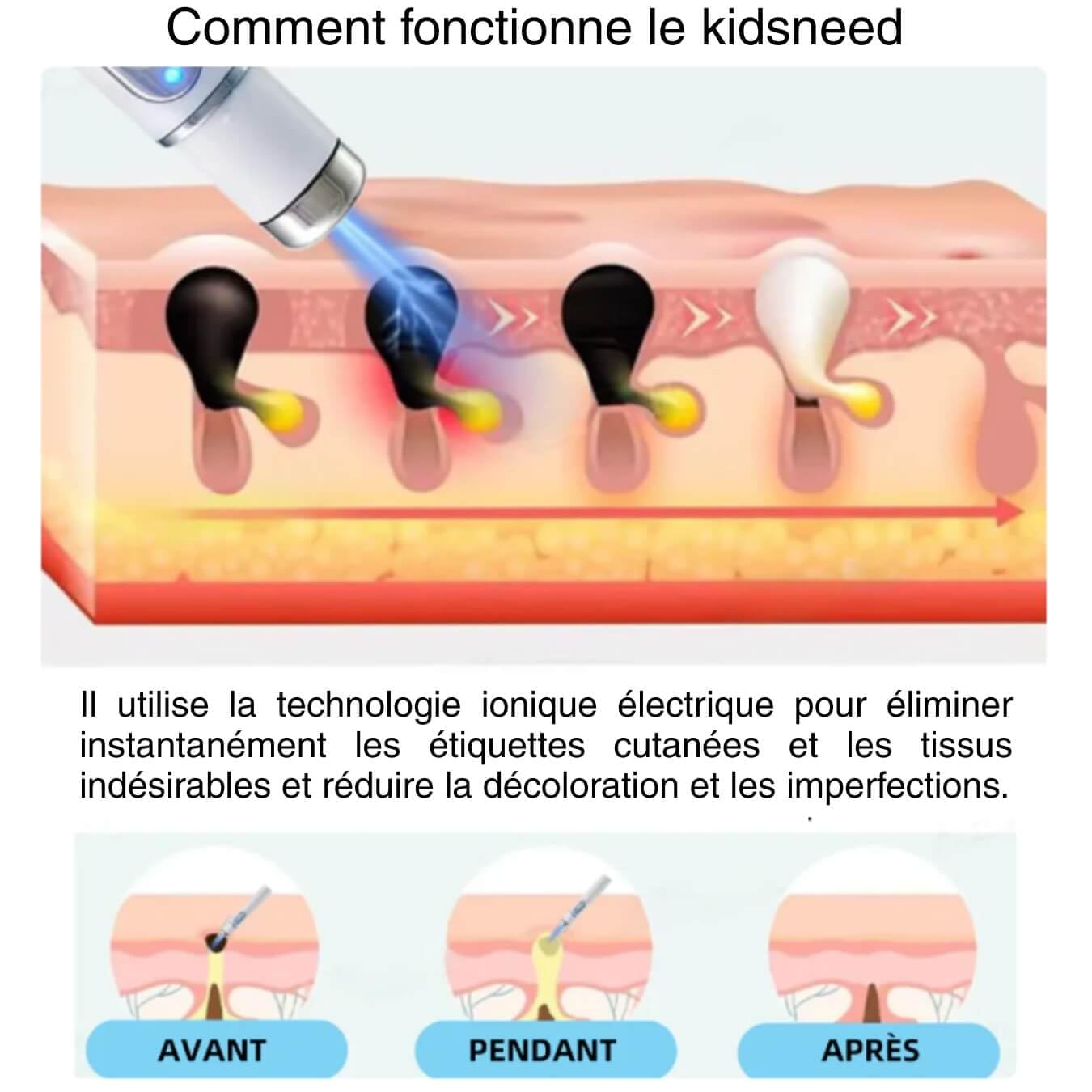 derma care Kidsneed 2.0 -Stylo Laser Non-Invasif L'élimination Efficace Des Verrues et Grains de Beauté