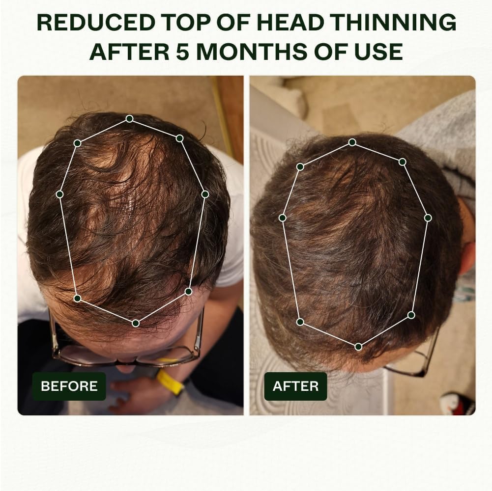 Scandinavian Biolabs Bio-Pilixin® Routine For Men | Helps With Hair Shedding, Nurtures Hair Follicles, Enhances Hair Strength, Repairs Damaged Hair, Clinically Tested, Dermatologically Approved - Image 4