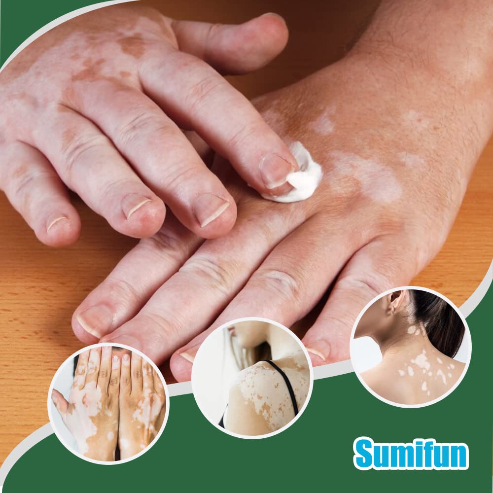 Sumifun Vitiligo Care Cream, Vitiligo Treatment, Reduces White Spots on