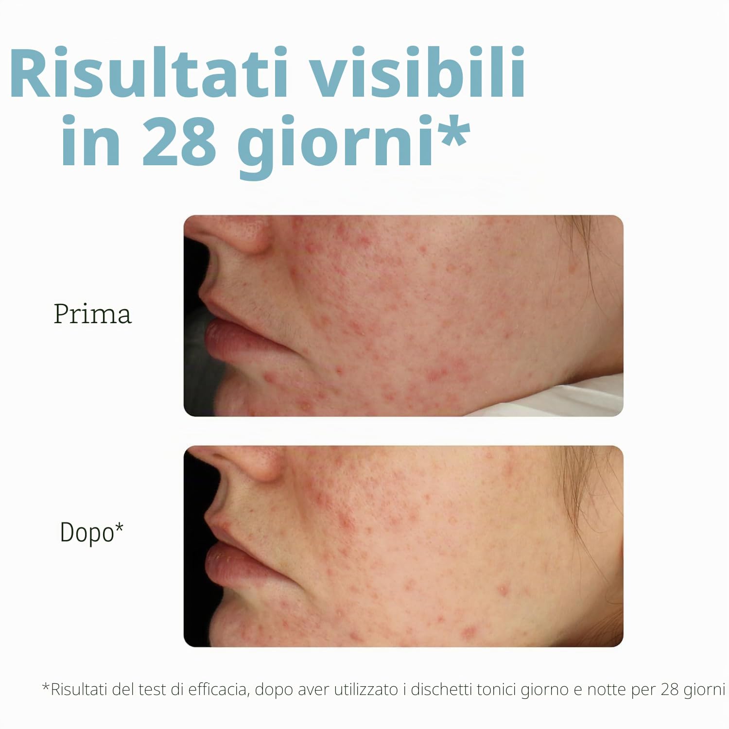 Iroha Nature - Dischi Tonici Esfolianti con Acido Salicilico e Probiotici | Per pelle acneica | Riduce imperfezioni | 50 dischi biodegradabili