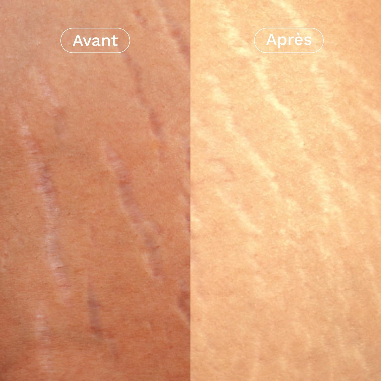 OMUM - La Surdouée Duo Crème et Huile - Prévention vergetures - Protège, régénère la peau, prévient la formation des vergetures - Compatible grossesse dès 1er mois - Vegan - 150 ml et 100 ml