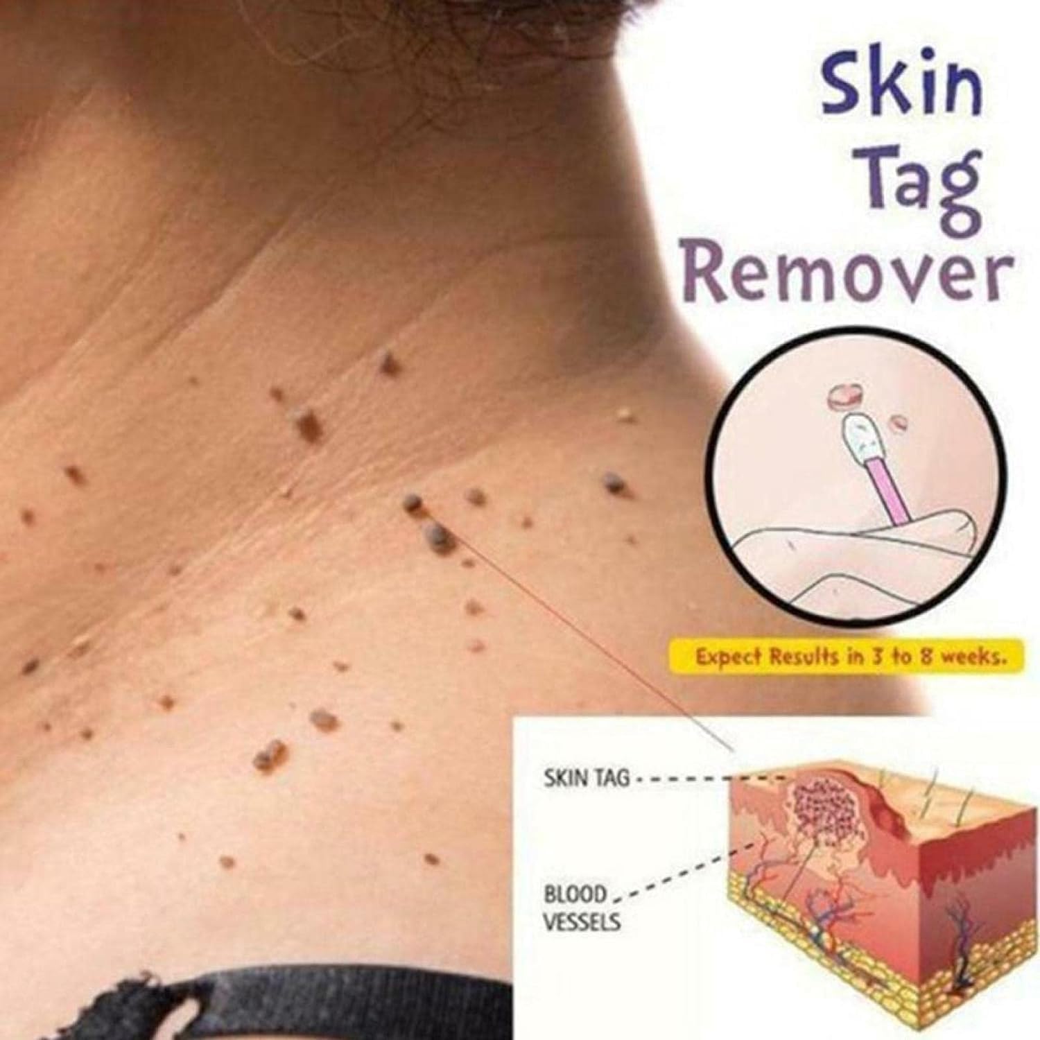 5Pcs Genital Wart ​Treatment Papillomas Removal Warts Liquid Remove Fast Effective Wart Remover Pen 3ml