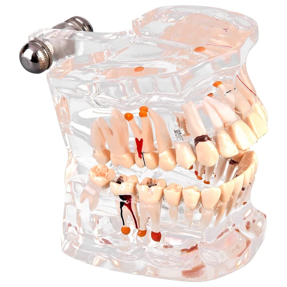 Walfront Modèle de Dents Amovibles, Transparent Dentaire Implant Disease Enseignement Étude Standard Dents Modèle Démonstration Pathologique