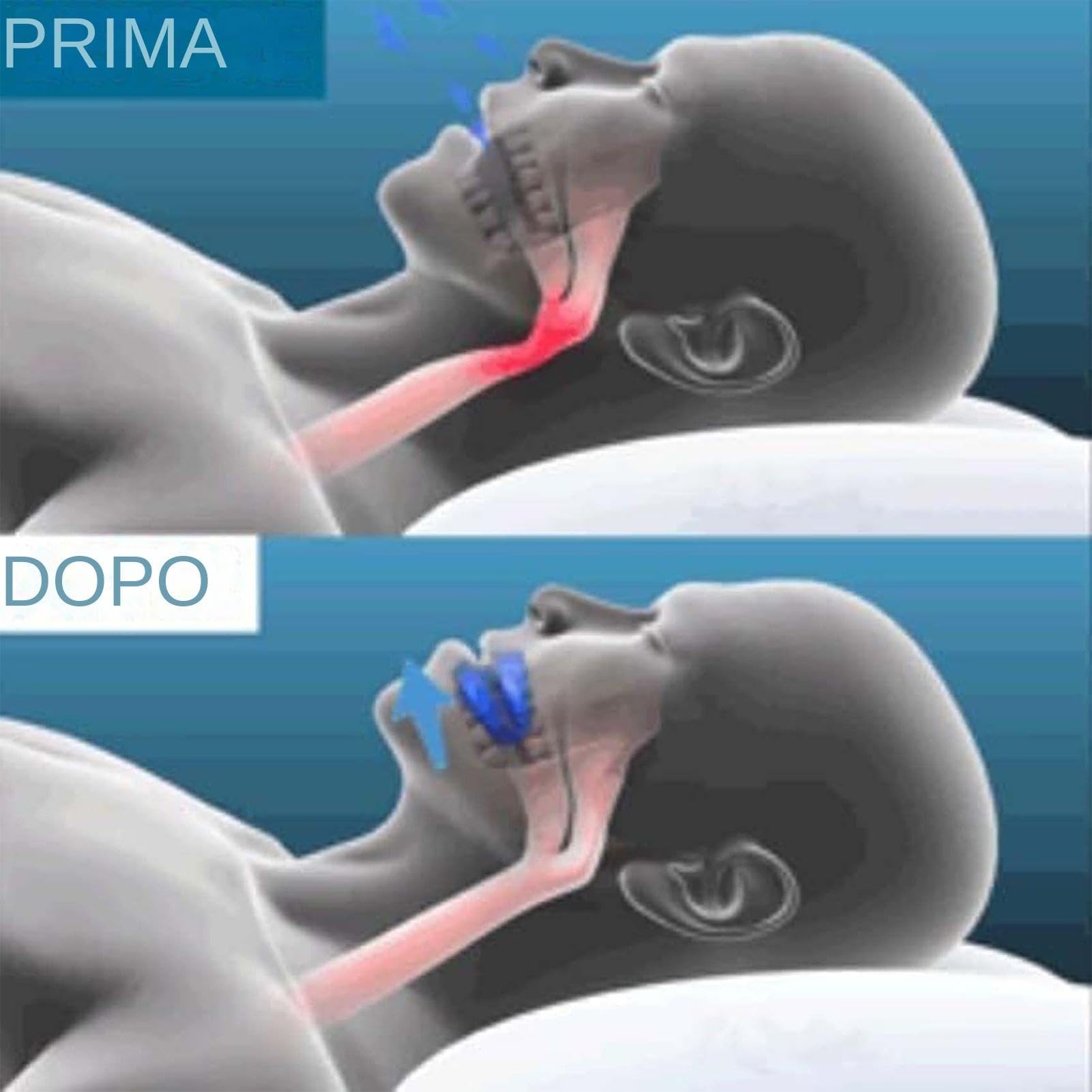 RinovaX - Bite anti-russamento silenzioso universale (1 pezzi)
