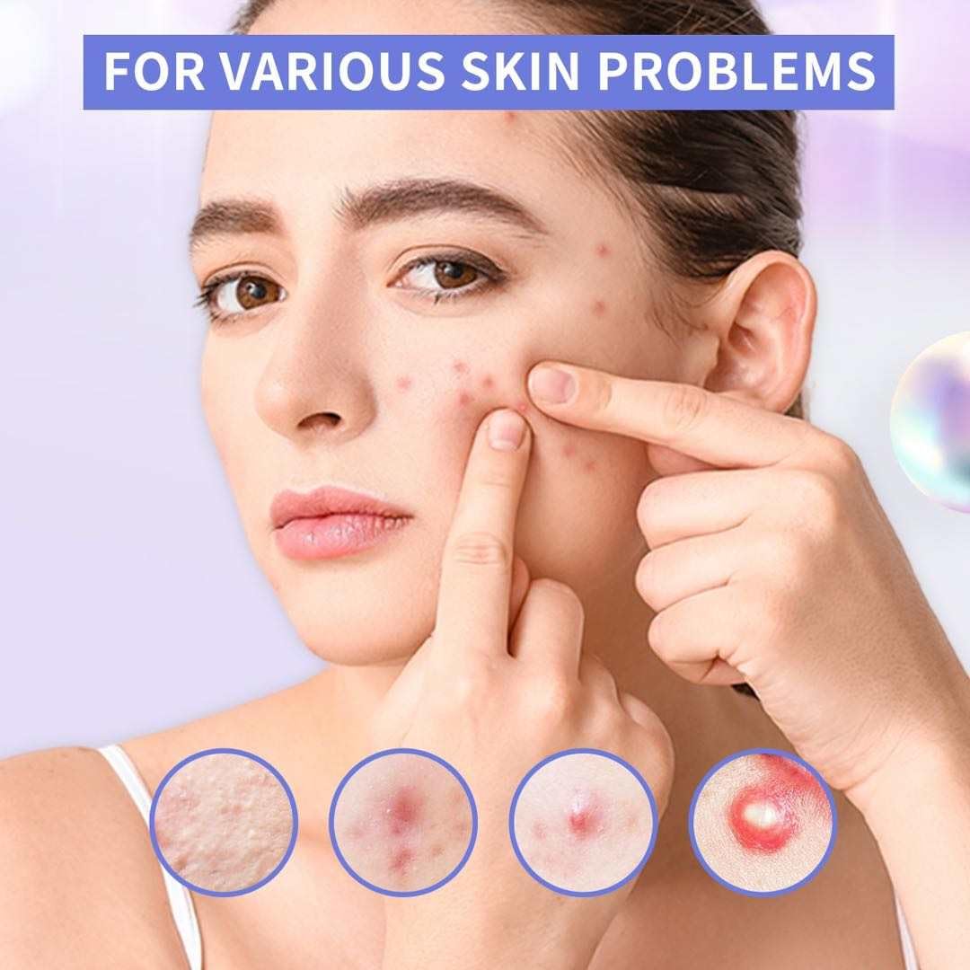 Pimple Patch Spot Treatment by Nova Cosmetics, 36 Hydrocolloid Pimple Patches for Day & Night Acne Care - Image 2