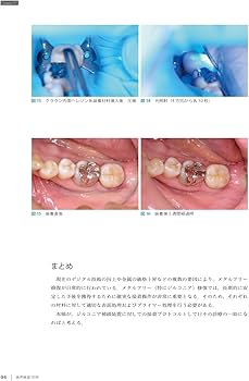 歯界展望別冊 モノリシックジルコニアレストレーション [雑誌] | 三浦