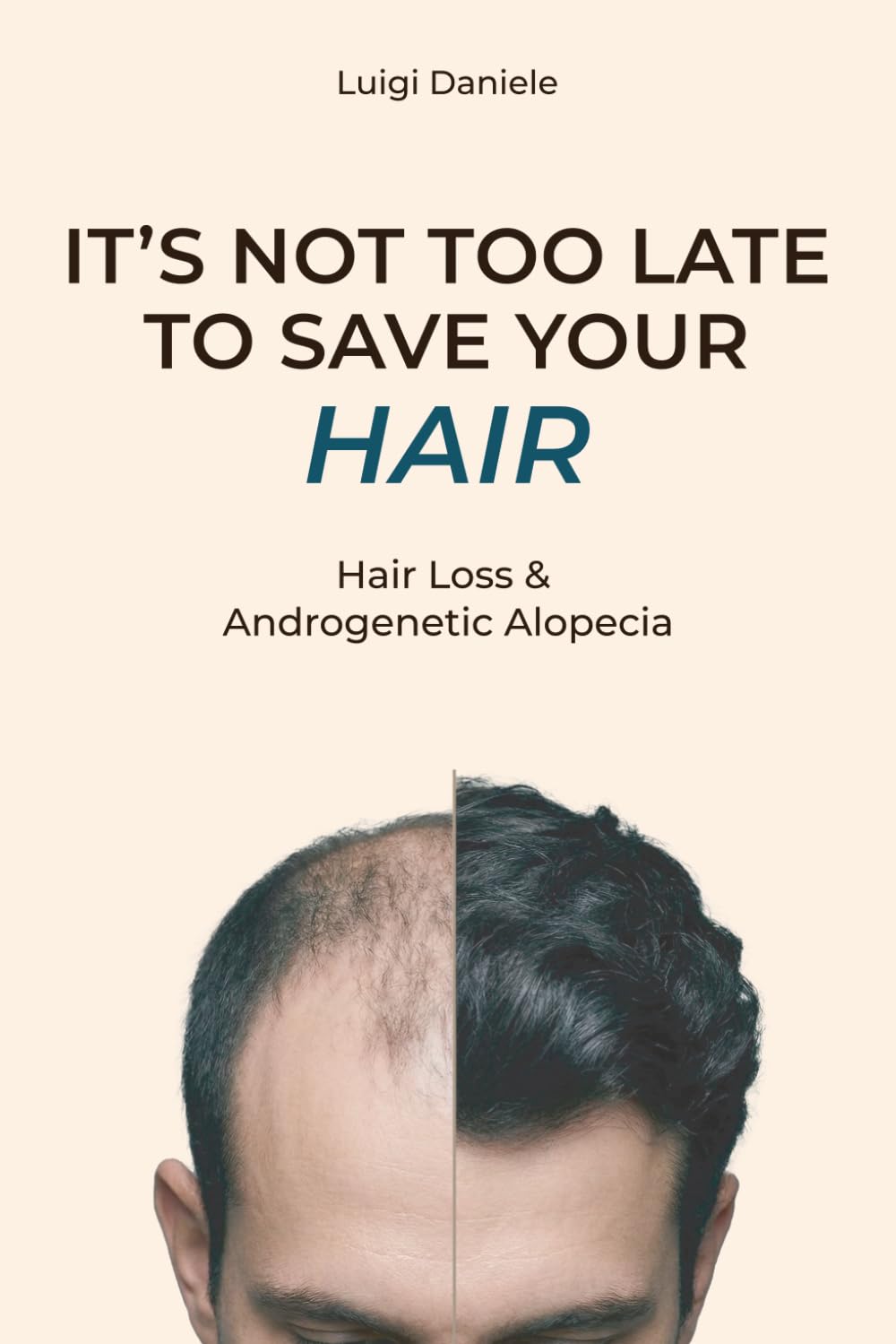 It's Not Too Late to Save Your Hair: Hair Loss & Androgenetic Alopecia