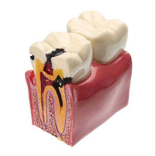 Amazon.com: Dental Caries Tooth Model, YOUYA DENTAL Decay Teeth ...
