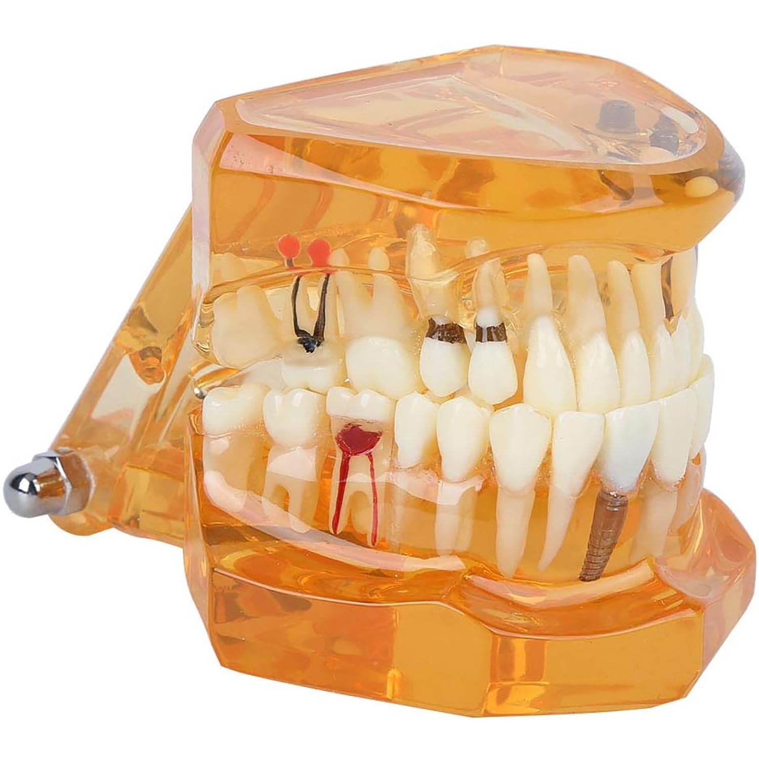 Pomarańczowy zdejmowany model zębów dentystycznych, model dentystyczny, nauczanie chorób zębów, model zębów implantologicznych, do komunikacji lekarz-pacjent