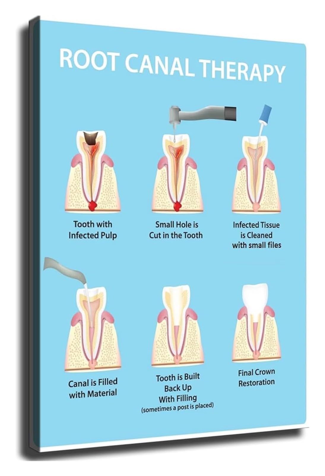 VWWJCCRO Root Canal Information Poster Wall-Art for Decor(Unframed,12x18inch(30x45cm))