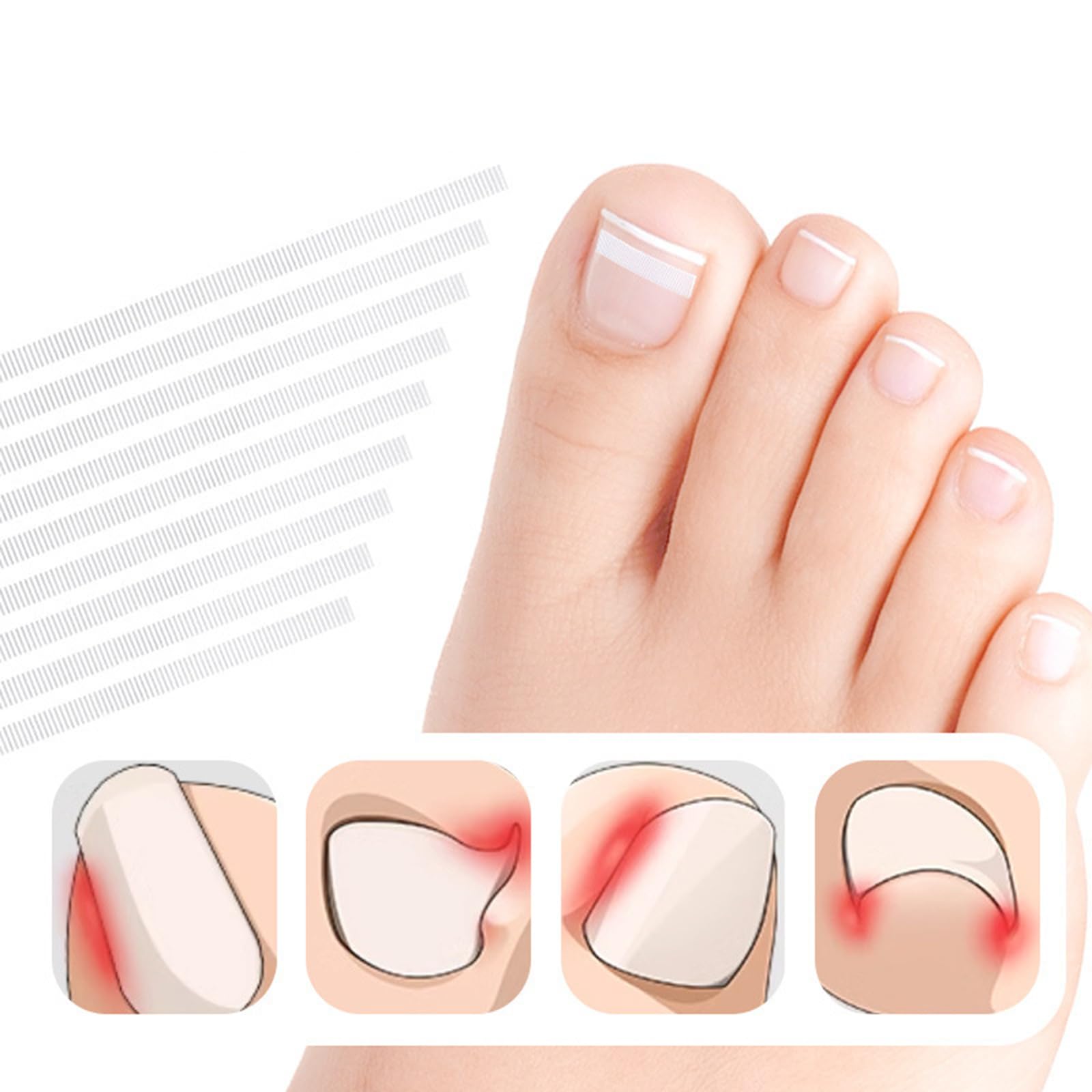 Ingrown Toenail Corrector Patches Ingrown Toenail Treatments Tool Foot Care 5pcs Ingrown Toenail Corrector Strips
