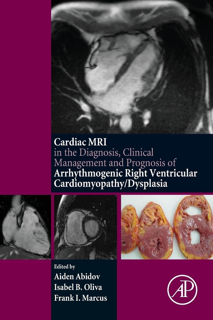 Buy Cardiac MRI in Diagnosis, Clinical Management, and Prognosis of Arrhythmogenic Right Ventricular Cardiomyopathy/Dysplasia — BookShops.in